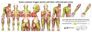 trigger points physiothérapie kinésithérapie des points gachette musculaires